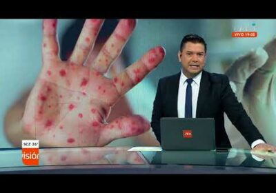 Debido a la ausencia de reactivos enviaran pruebas de sospechosos de viruela del mono al exterior