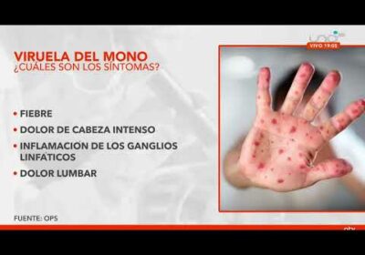 ¿Qué es la viruela del mono y cuales son sus síntomas?