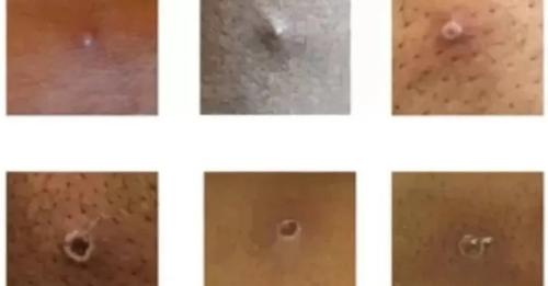 Viruela del mono: un estudio revela la causa del 95% de los contagios