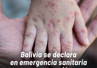 Los casos de sarampión subieron de 28 a 60 en menos de una semana…