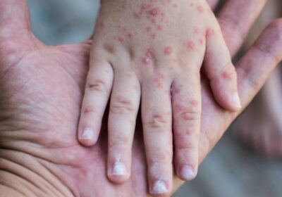 #GrupoFides | #ANF #Sociedad 𝐒𝐮𝐛𝐞 𝐚 𝟏𝟎𝟓 𝐥𝐨𝐬 𝐜𝐚𝐬𝐨𝐬 𝐜𝐨𝐧𝐟𝐢𝐫𝐦𝐚𝐝𝐨𝐬 𝐝𝐞 𝐬𝐚𝐫𝐚𝐦𝐩𝐢ó𝐧 𝐞𝐧 𝐁𝐨𝐥𝐢𝐯𝐢𝐚…