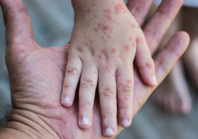 #Urgente | Confirman el primer caso positivo de sarampión en la ciudad de #Sucre…