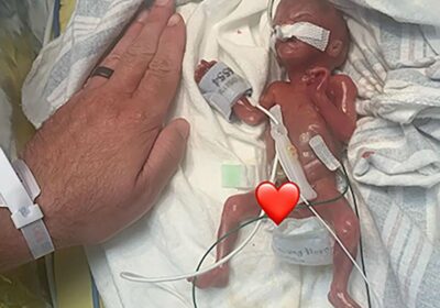🇺🇸 | Un bebé de Iowa nacido con solo 21 semanas de gestación rompió…